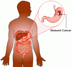 Know the component factors and reasons for Gastric cancer